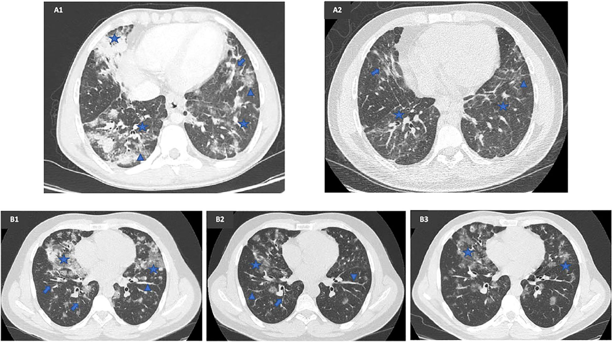 ベース Conti All Balls Racing 3/4