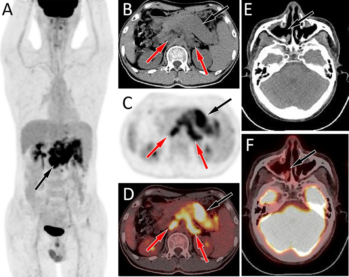 Frontiers | Case Report: 18F-FDG PET/CT revealed diffuse