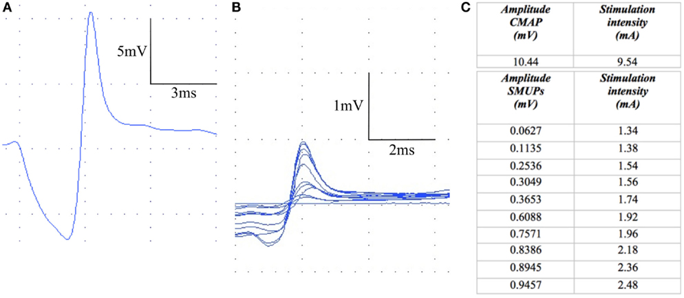 Frontiers | The Potential Role of Motor Unit Number Estimation as an ...
