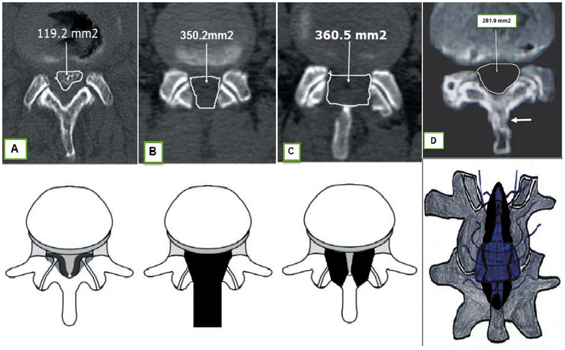 Frontiers Outcome After Surgery Of Lumbar Spinal Stenosis A Randomized Comparison Of 