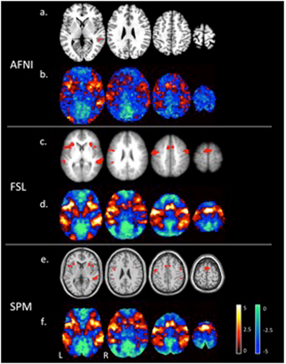 Frontiers | Exploring fMRI Results Space: 31 Variants of an
