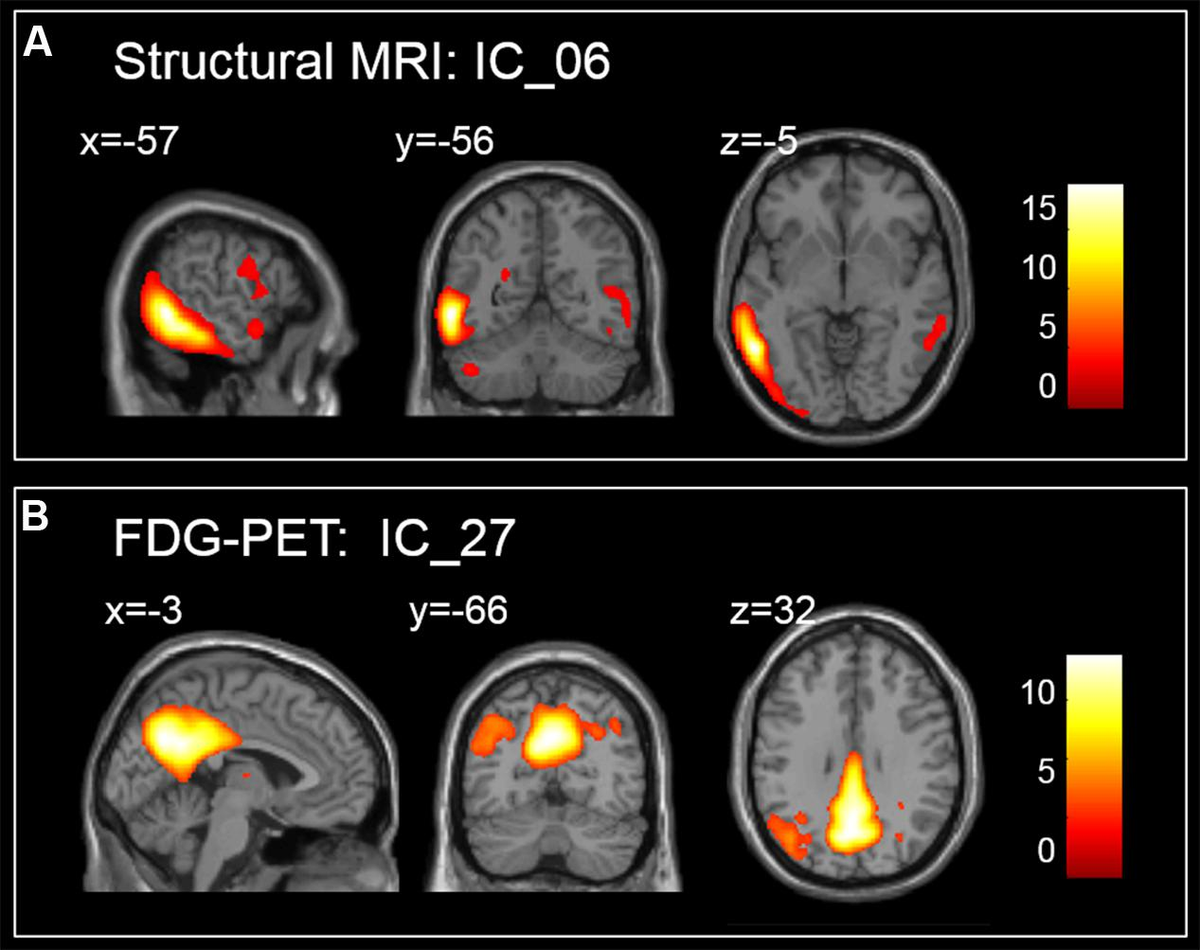 Frontiers | Prediction of Mild Cognitive Impairment