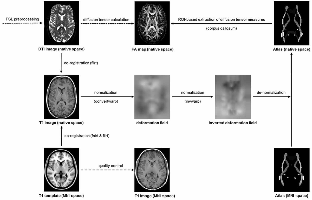 Frontiers Structural Alterations In The Corpus Callosum Are Associated With Suicidal Behavior 0488