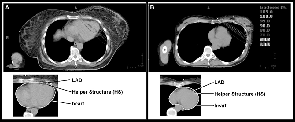 健康・医学 Radiotherapy Techniques in Breast Cancer Danish breast cancer radiotherapy techniques reconstructed