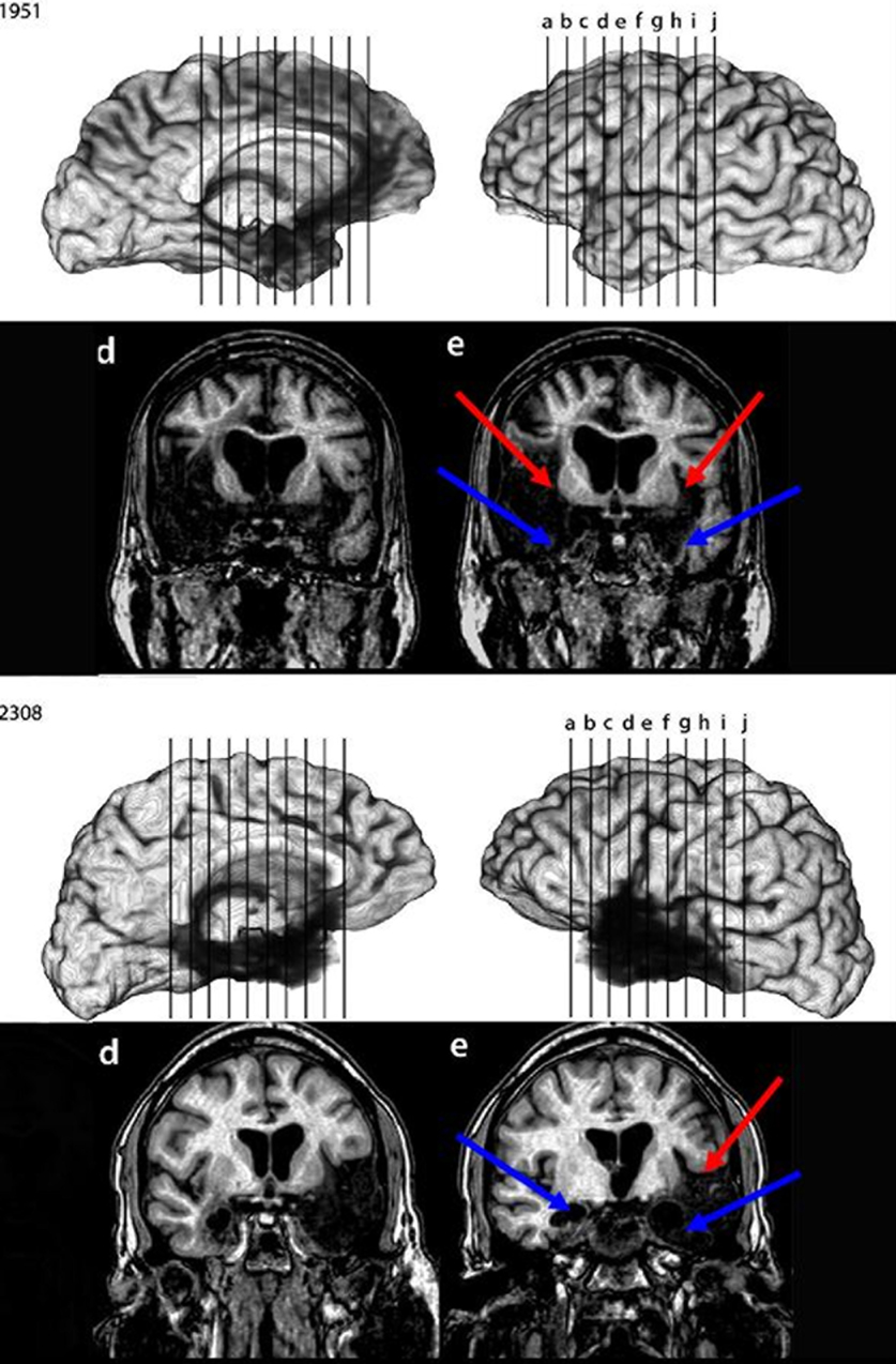 Frontiers | Hippocampal amnesia impairs all manner of