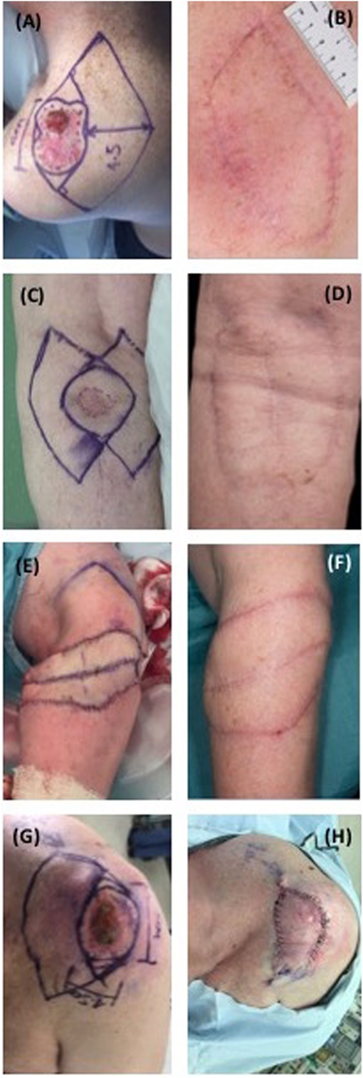 Frontiers | The Use of Keystone Flaps in Periarticular Wound