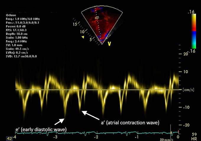 Frontiers | Cardiac and Vascular Target Organ Damage in