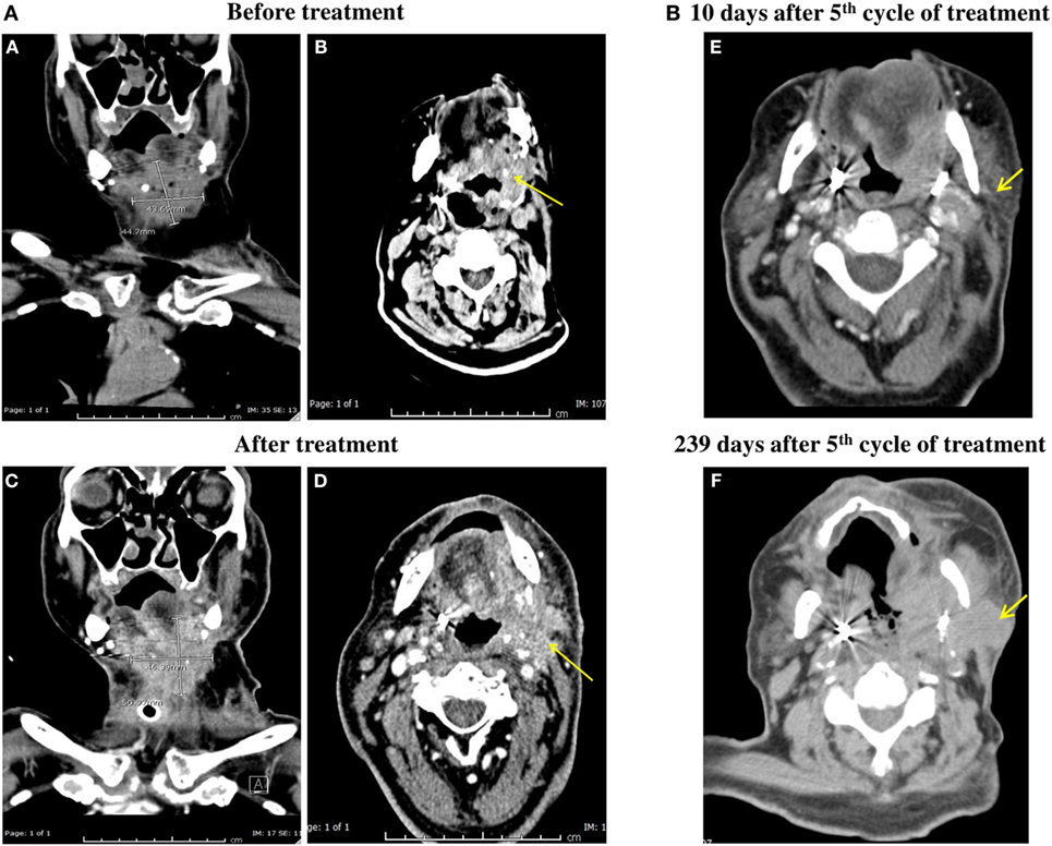 裁断済　臨床頭頸部癌学 = Clinical Head and Neck On Detectability of Head and Neck Cancer via New Computed