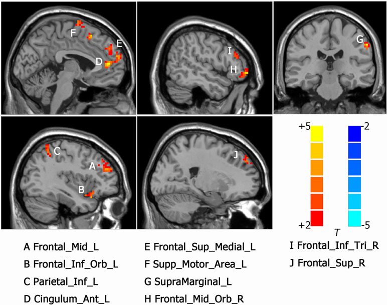 Frontiers | Altered Brain Function in Drug-Naïve Major