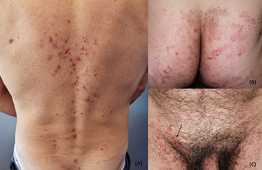 Dermatitis herpetiformis hotsell