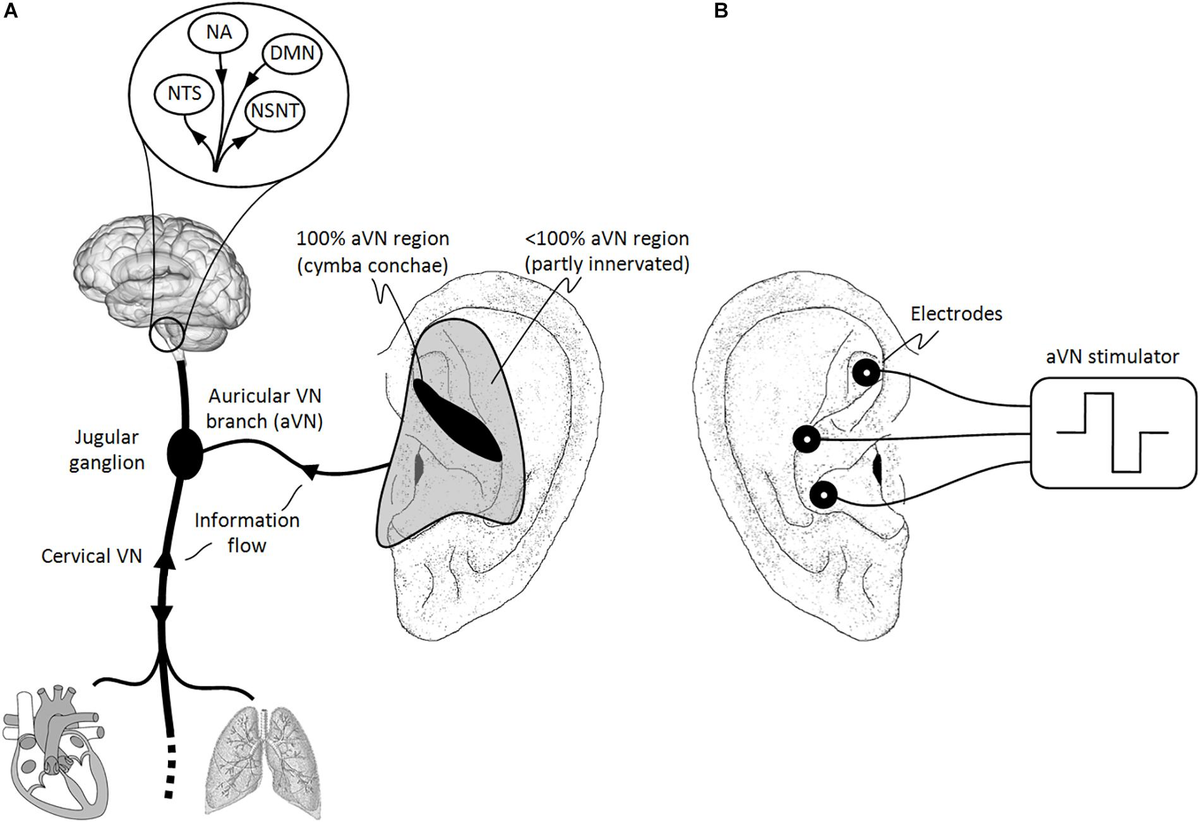 Vagus nerve and tinnitus outlet