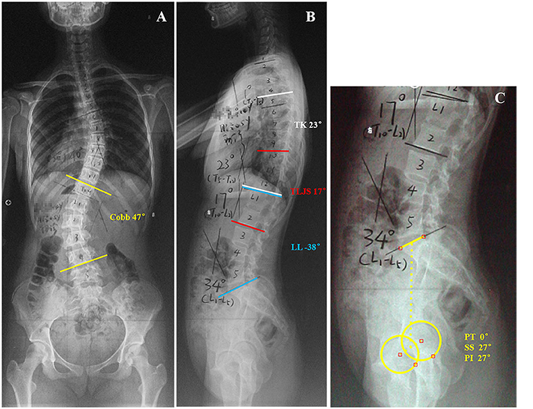 Frontiers | PI and T9-SPI: New Predictive Factors for