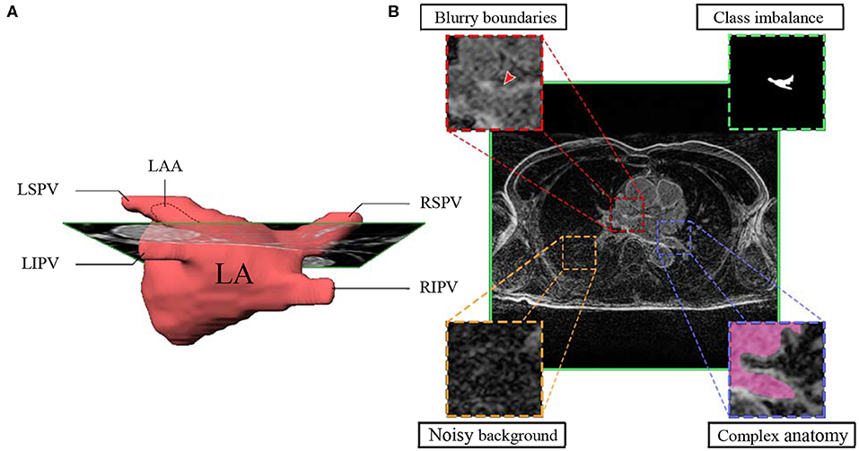 Frontiers | Mini Review: Deep Learning for Atrial