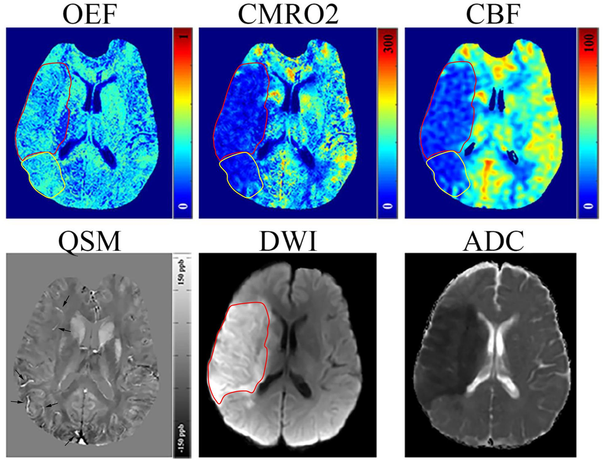 Automated MRI perfusion-diffusion mismatch estimation may be