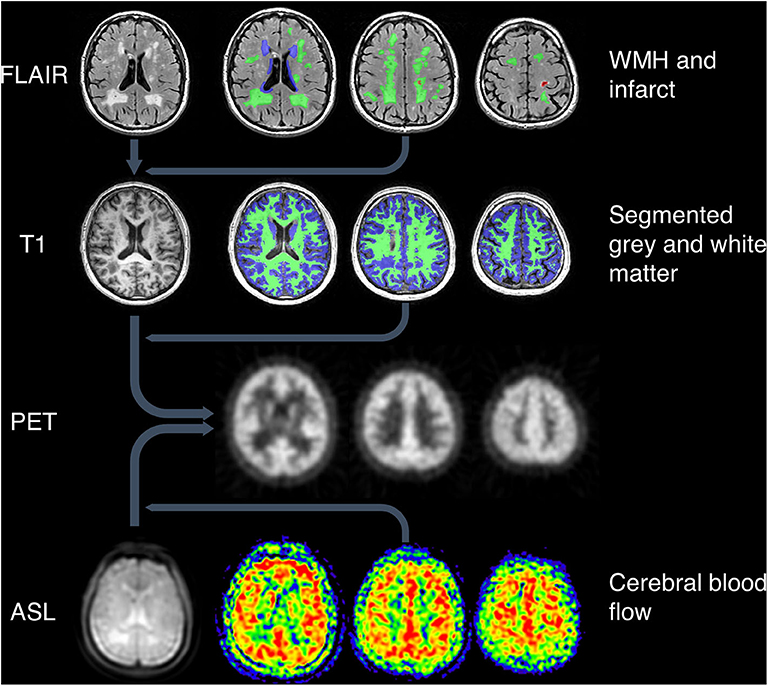 Frontiers | Patterns of Mitochondrial TSPO Binding in Cerebral 