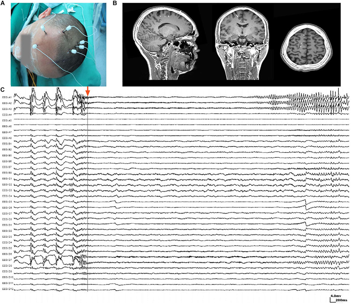 eeg 2011年 Frontiers | Beta Electroencephalographic Oscillation Is a