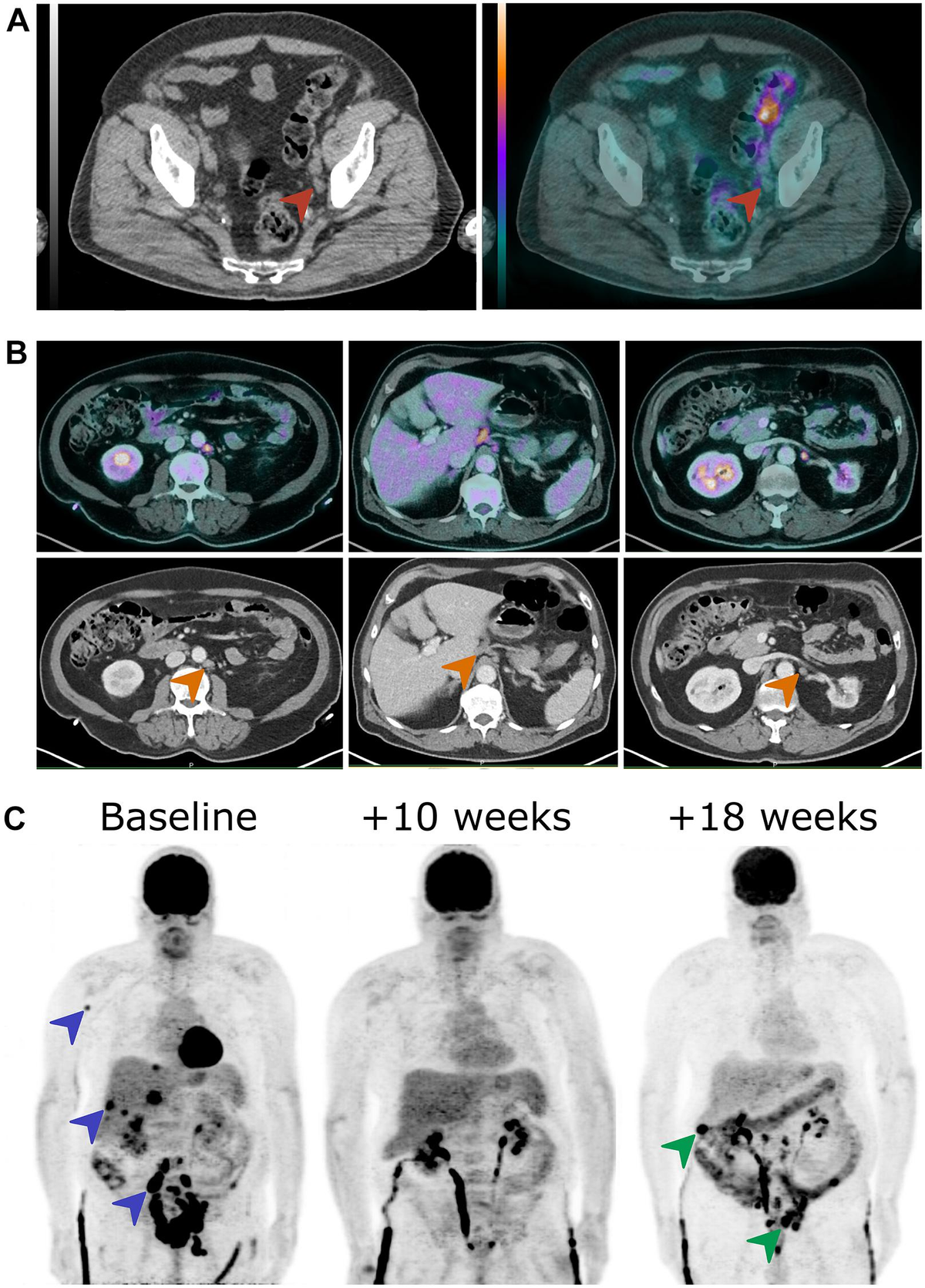 Frontiers | The Role of 18F-FDG PET/CT in Guiding Precision