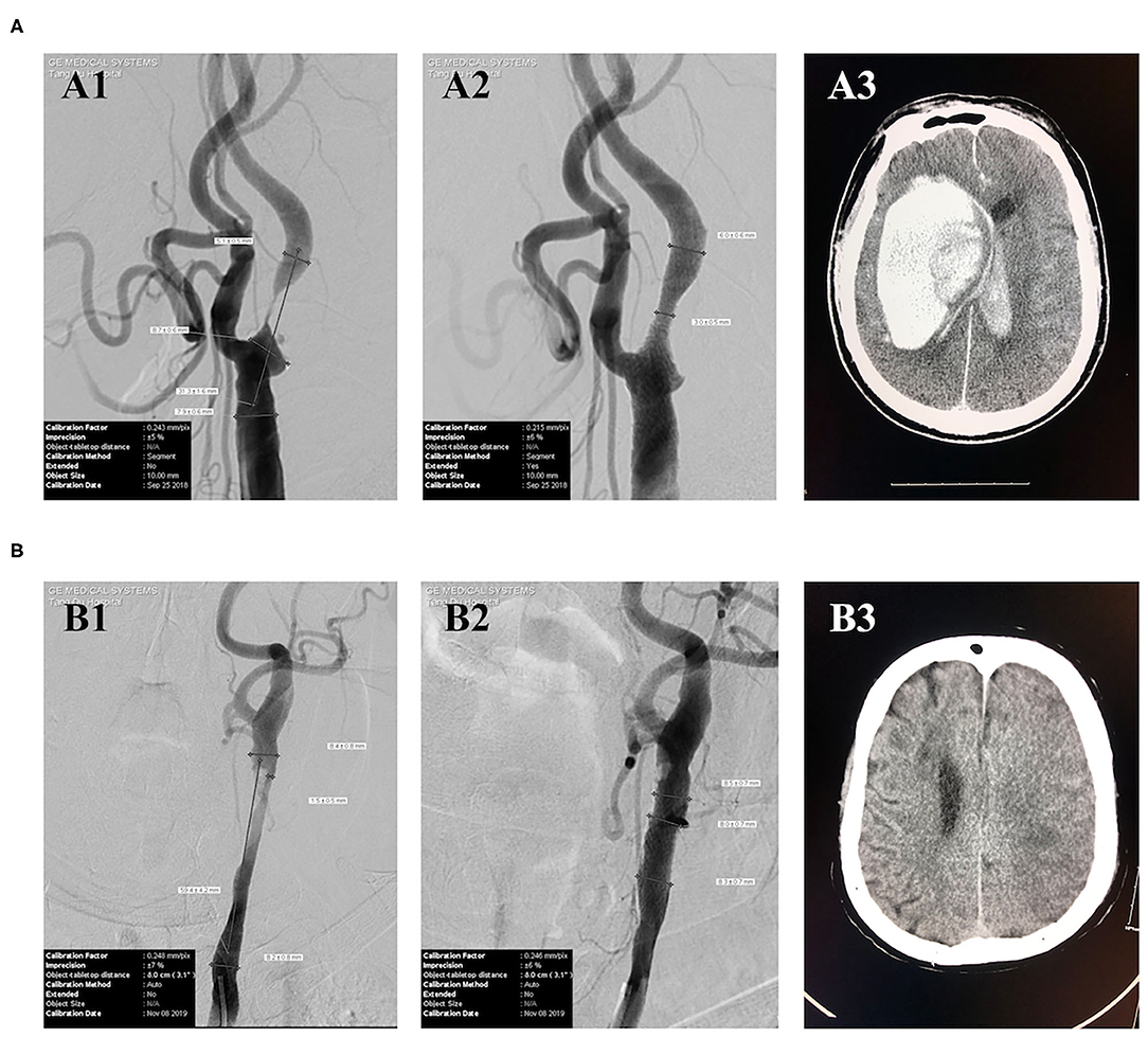 Frontiers | Perioperative Blood Pressure Control in Carotid Frontiers | Perioperative Blood Pressure Control in Carotid