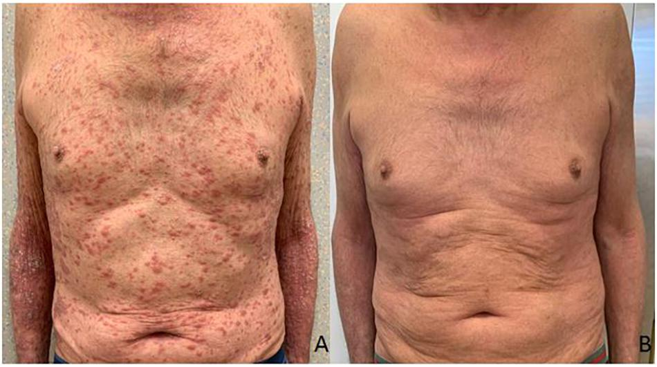 Frontiers | Pembrolizumab-Induced Psoriasis in Metastatic Melanoma ...