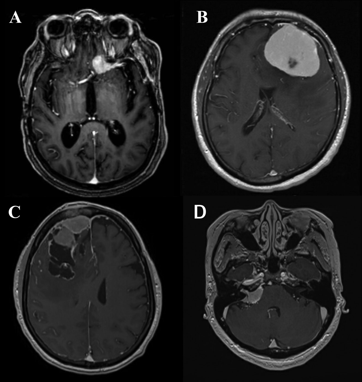 健康・医学 Meningiomas, Part II (Volume 170) i2 Frontiers | Meningioma: A Review of Clinicopathological and