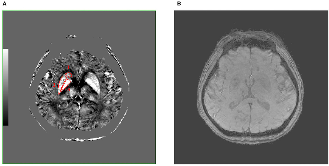 ボールガイ　mri Neuroimaging in AOA2. Midsagittal T1-weigthed brain MRI of
