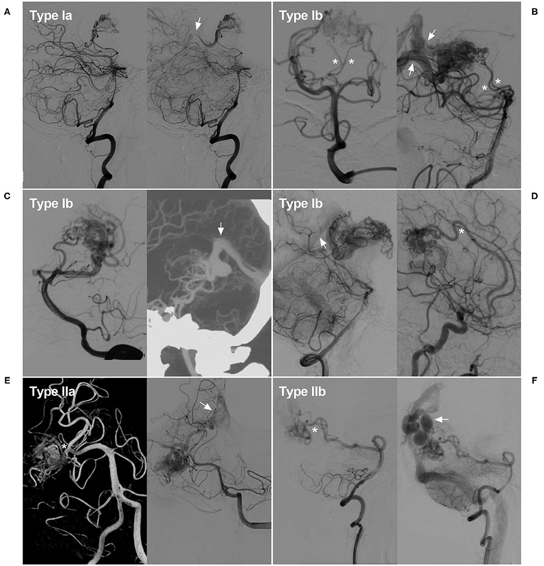 Frontiers | Imaging Characteristics and Endovascular