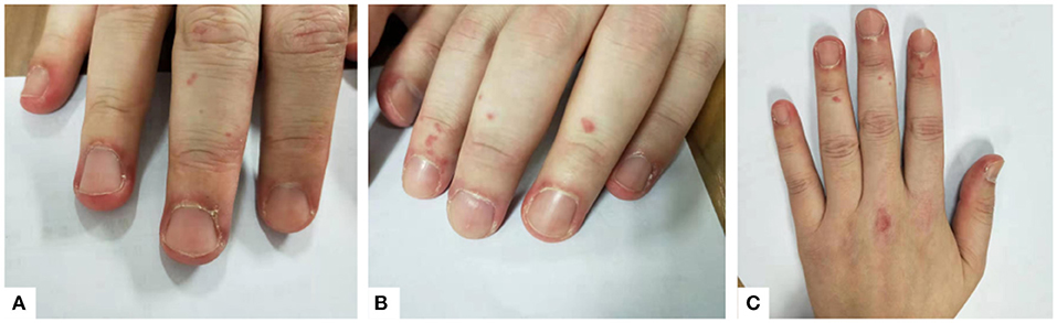 Frontiers | Case Report: Treatment of Anti-MDA5-Positive