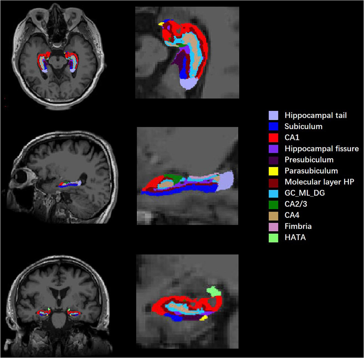 ち*ぷ様 ディアステマDiastema cf. fimbriatoloba Frontiers | Deviations in Hippocampal Subregion in Older