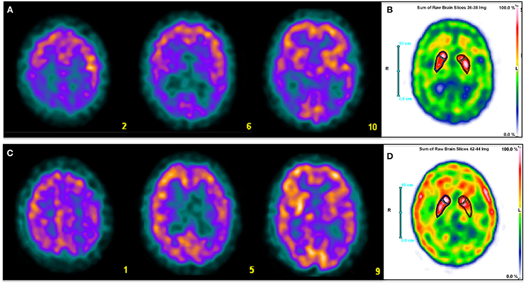殿堂 as SPECT Brain | Frontiers a Neurodegeneration of Biomarker 臨床医学