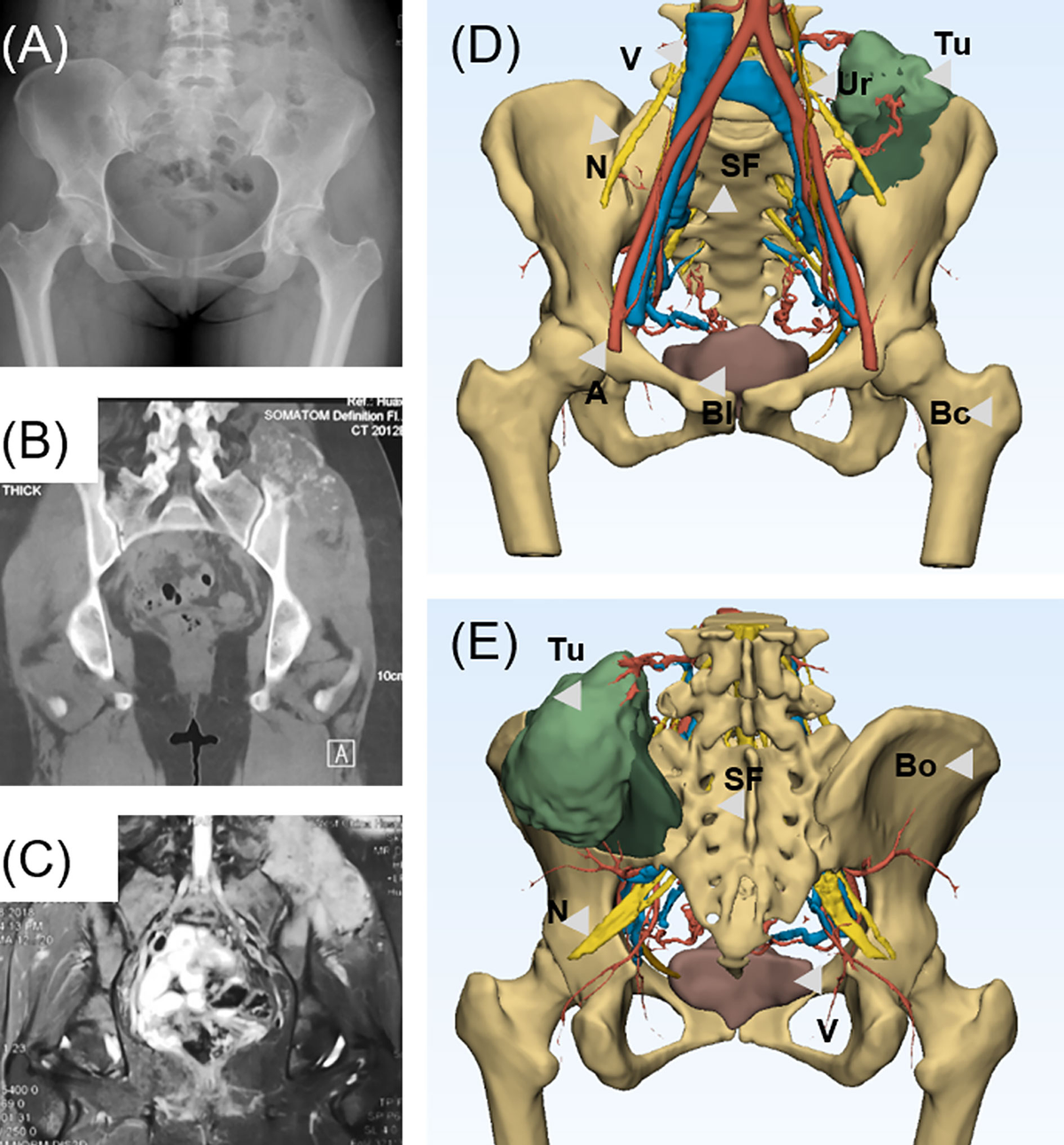 大腿骨近位部骨折 Osteosynthesis & Arthroplasty Metaphyseal sleeve and straight stem fixation with or