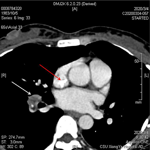 Frontiers | Case Report: Infective Endocarditis Caused by