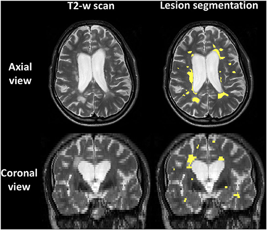 サーナイト　mri サーナイト mri MRI (FLAIR) shows increased number of supra and