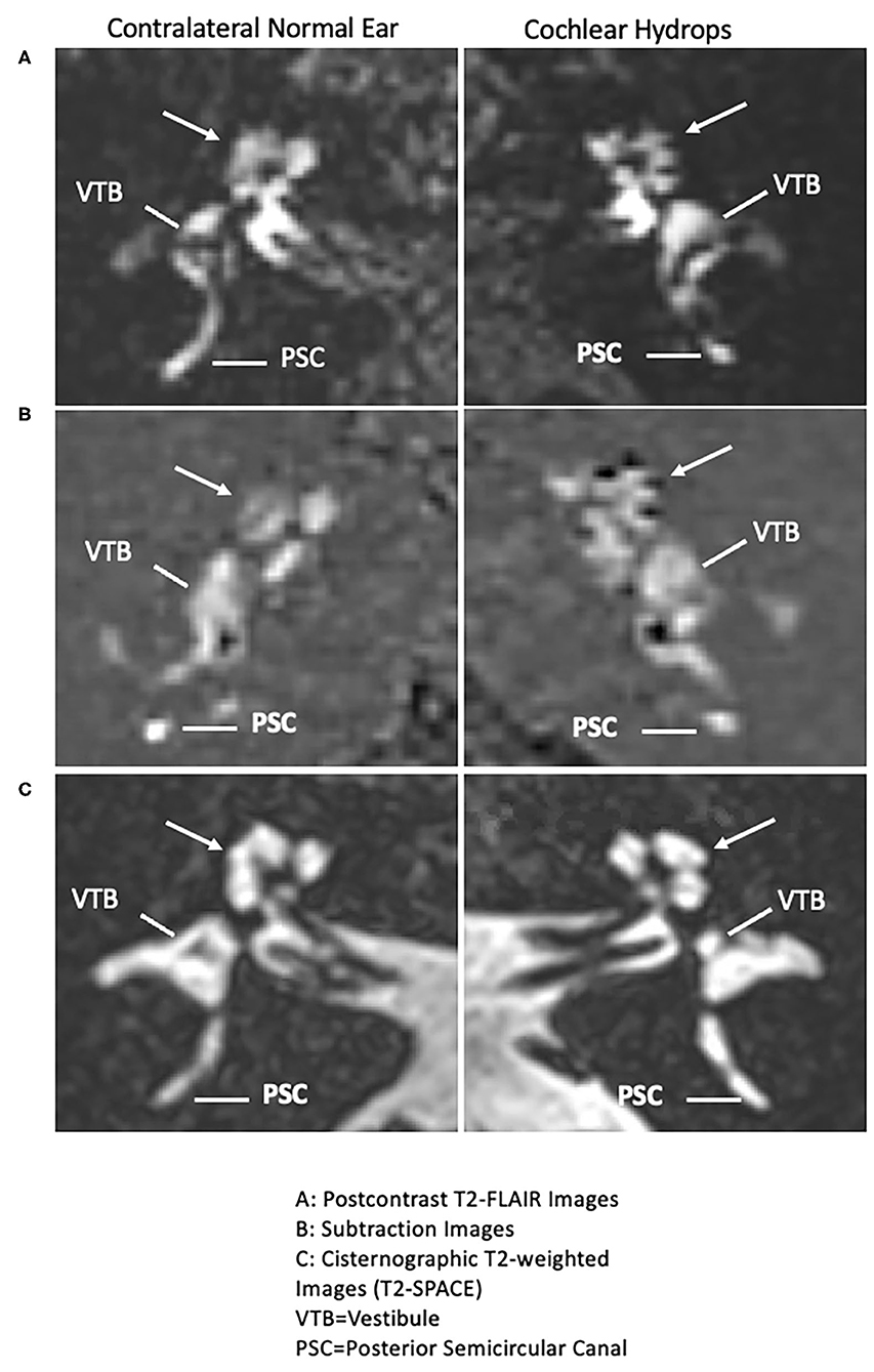 Frontiers Cochlear Meniere