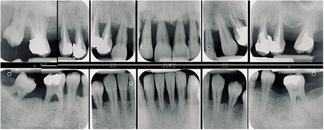 Frontiers | Rare Genetic Disorders Affecting the Periodontal