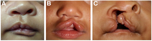 【美品】唇裂手術アトラス　ATLAS OF CLEFT LIP SURGERY دانلود کتاب Atlas of Cleft Lip and Palate & Facial Deformity
