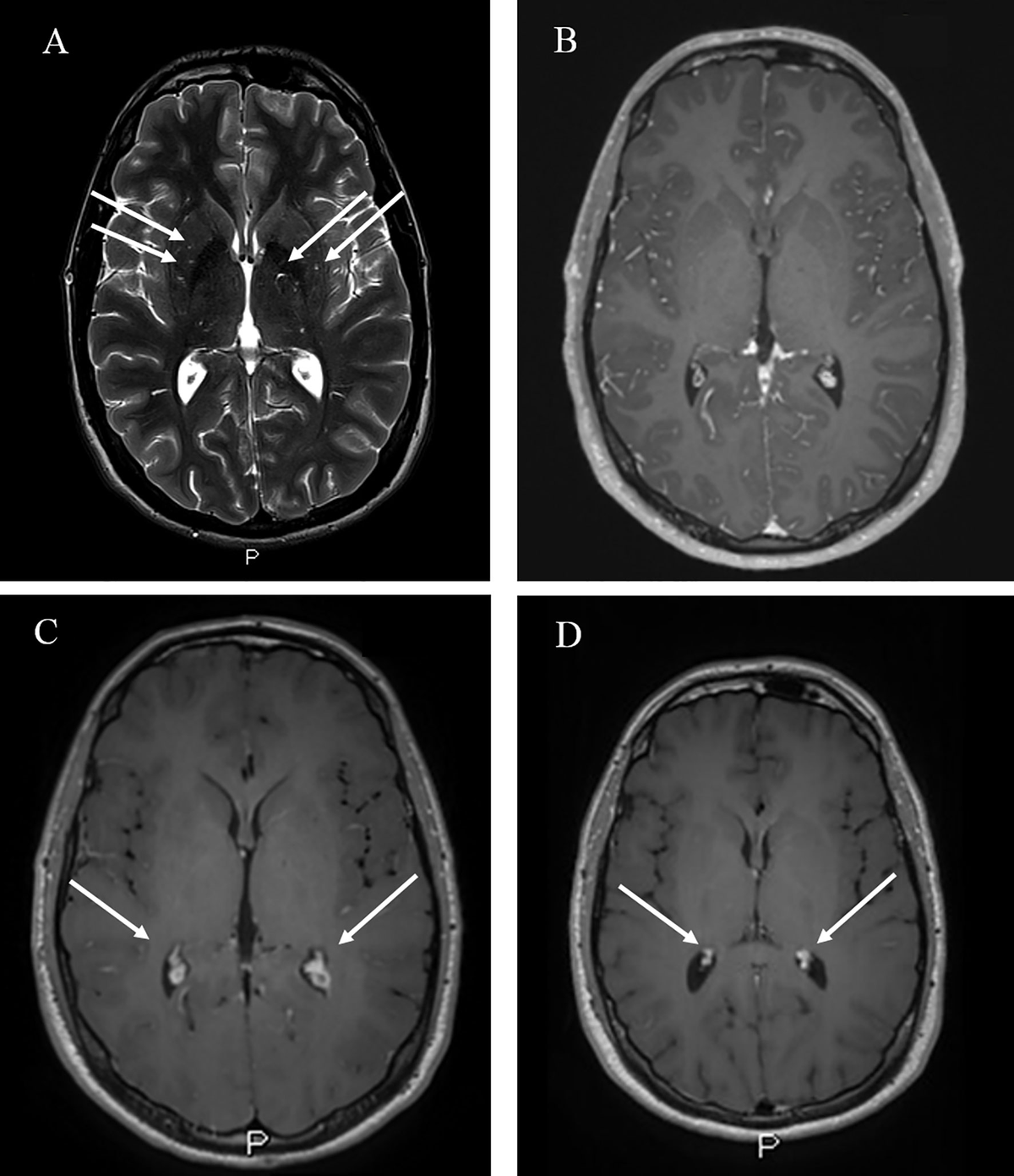 小児神経の画像診断 = Diagnostic Imaging of Infan… 小児神経の画像診断 = Diagnostic Imaging of Infan…
