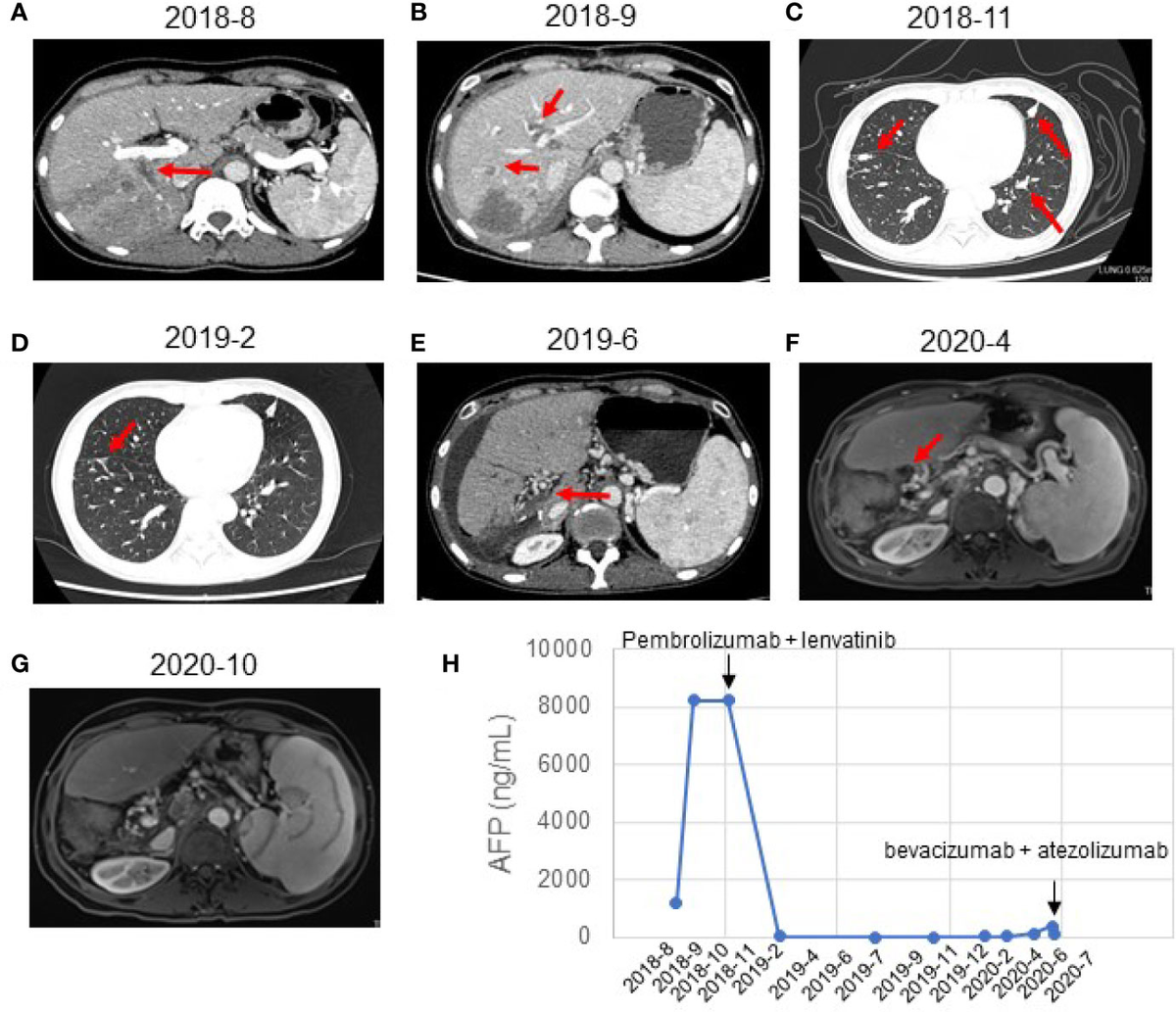 Cellular based immunotherapy for primary liver cancer