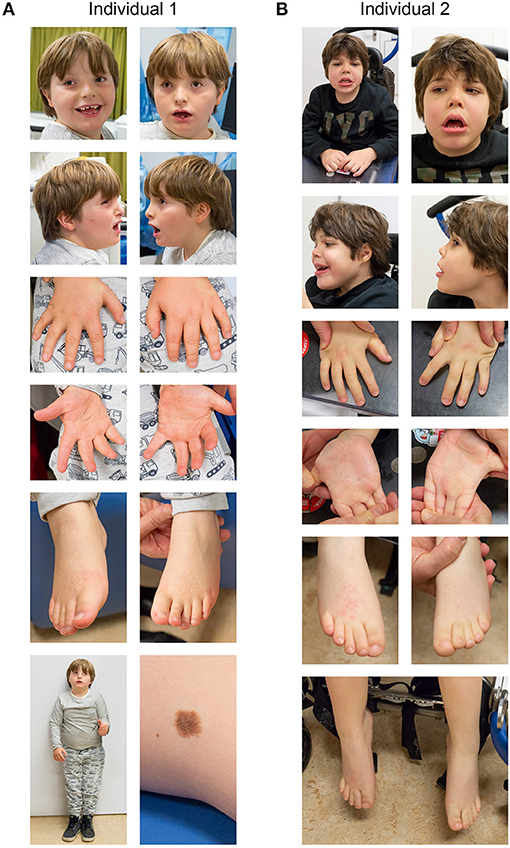 Frontiers | Case Report: Two New Cases of Chromosome 12q14 