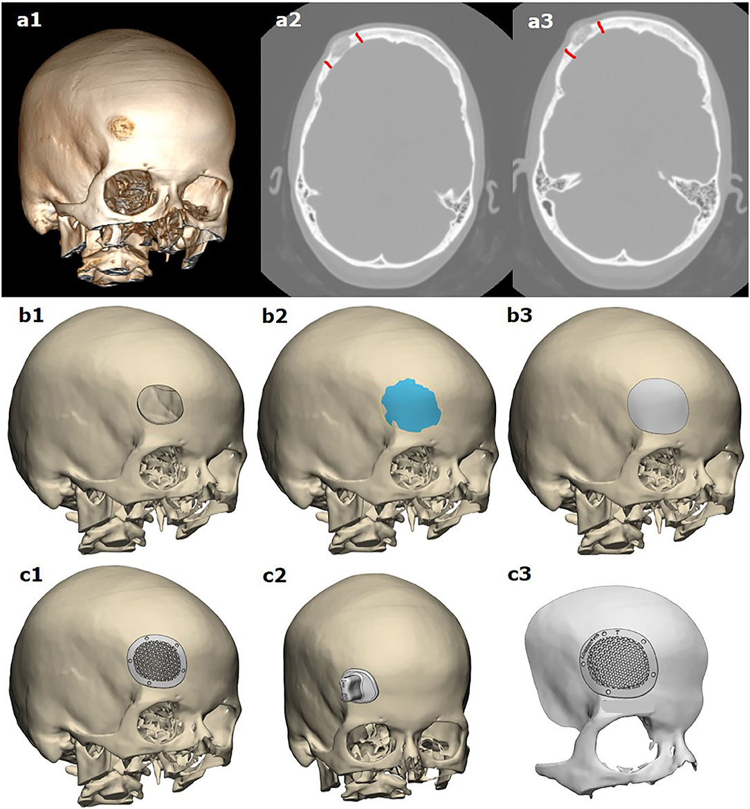 ＼半額SALE／ Frontiers Bone of Resection Simultaneous Report: Case | 健康・医学