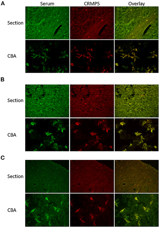Frontiers | CRMP5 Antibodies—Diagnostic Challenges