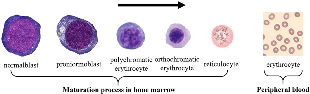 Red Blood Cell (RBC):- Part 5 - RBC Morphology Differential Diagnosis