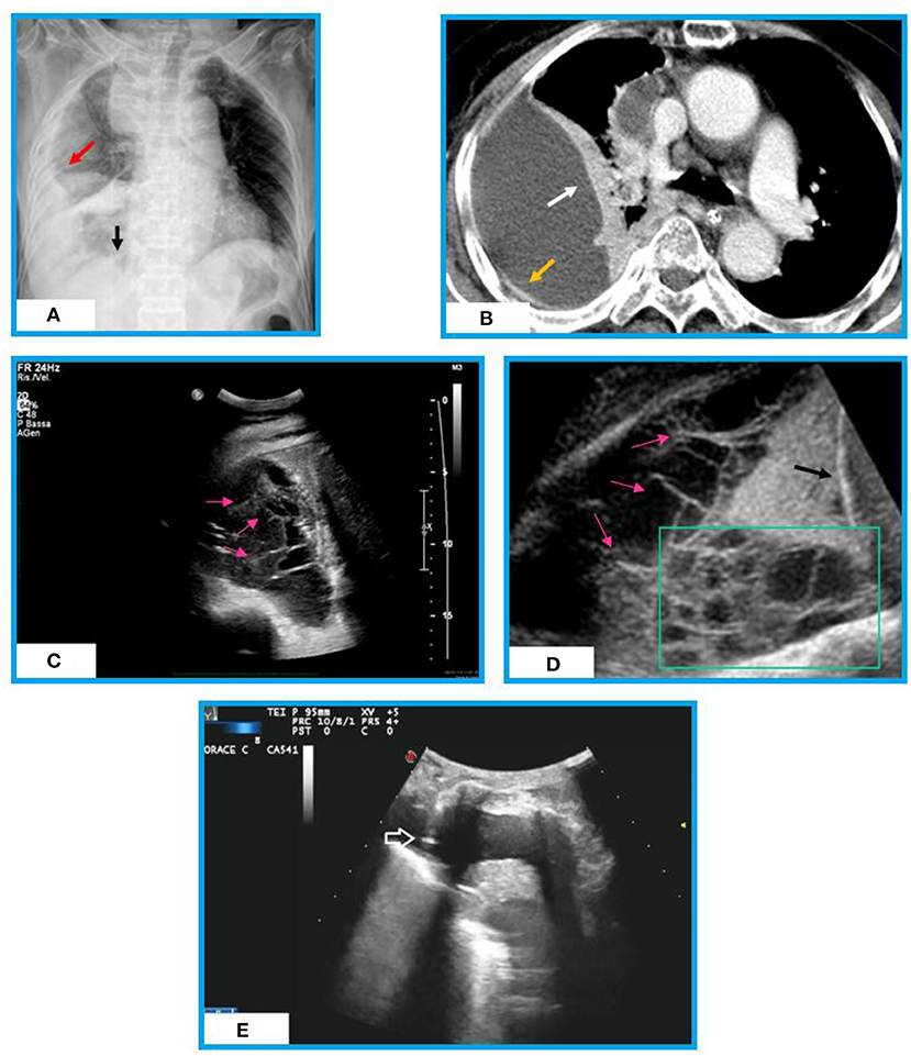 Frontiers | Chest Imaging in the Diagnosis and Management of