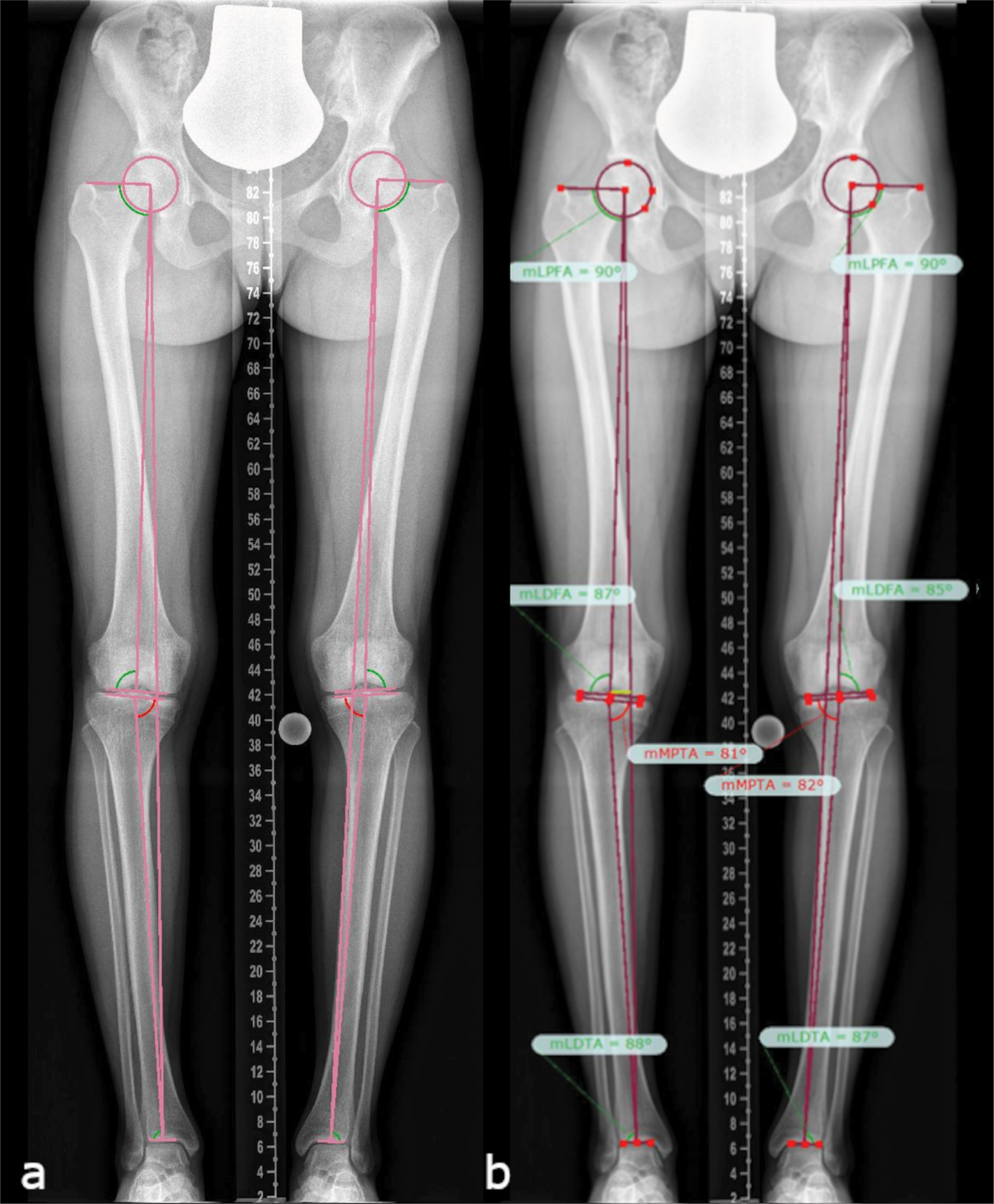 Frontiers | Lower Limb Deformity and Gait Deviations Among