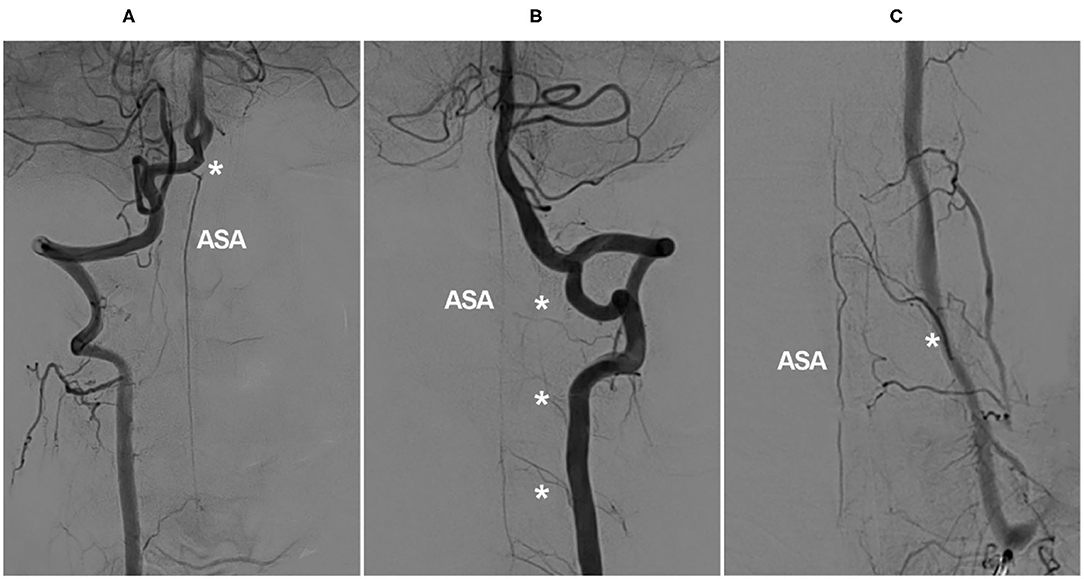 Frontiers | Role of the Cervical Anterior Spinal Artery in