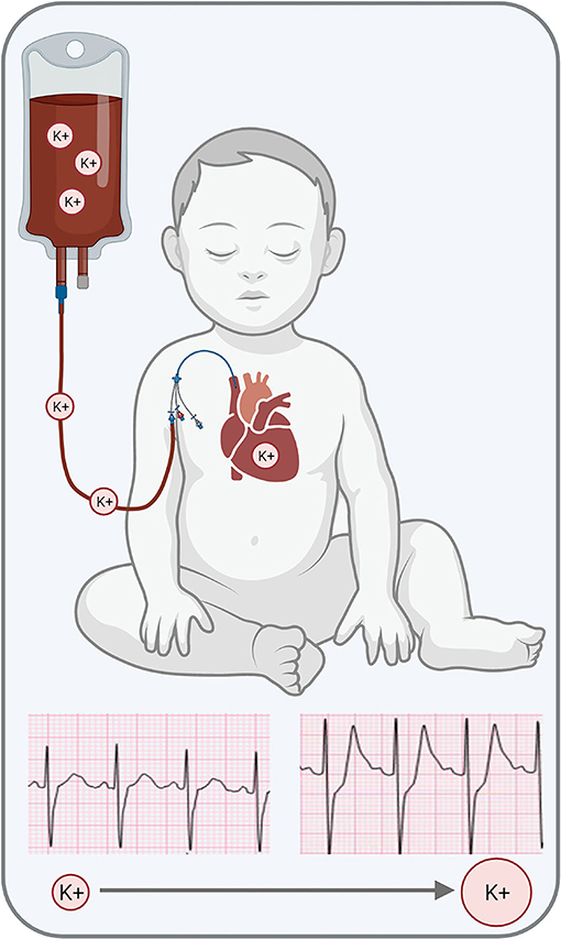 Frontiers TransfusionAssociated Hyperkalemic Cardiac Arrest in