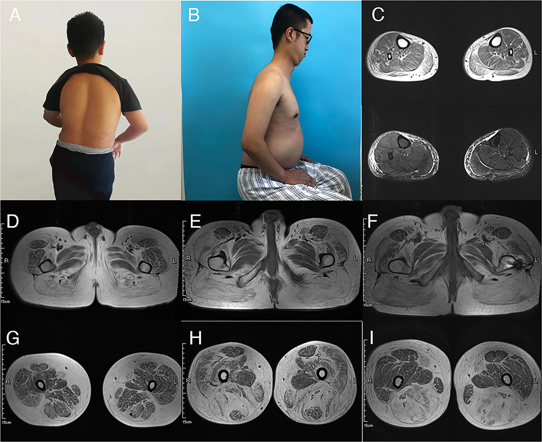 Muscle Diseases (神経学) Core-rod myopathy due to a novel mutation in BTB/POZ domain
