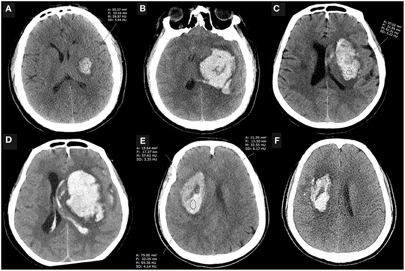 New Insights in Intracerebral Hemorrhage (Frontiers of Neurology and Neuroscience) [ハードカバー] Toyoda， Kazunori? Anderson， Craig S.; Mayer， Stephan A. Frontiers | Therapeutic strategies for intracerebral hemorrhage