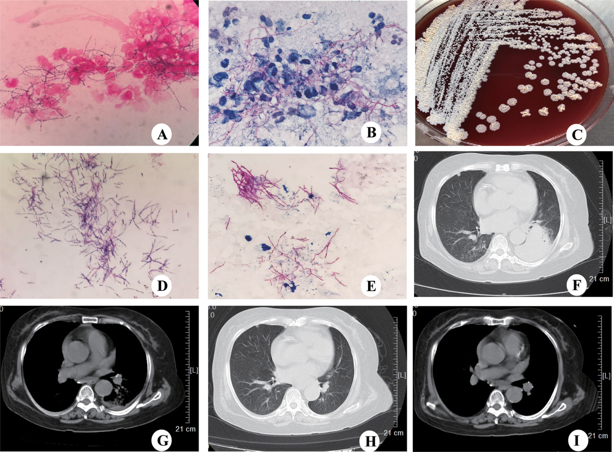 Frontiers | Nocardia Infection in Nephrotic Syndrome