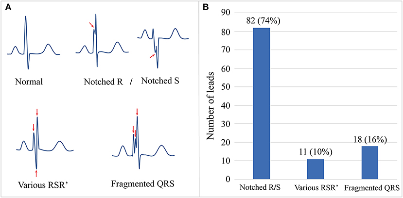 Frontiers | Relationship Between Fragmented QRS Complex and