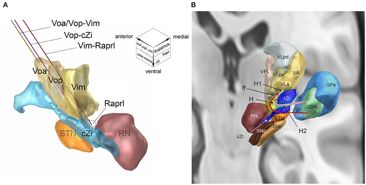 Frontiers | A Single DBS-Lead to Stimulate the Thalamus and